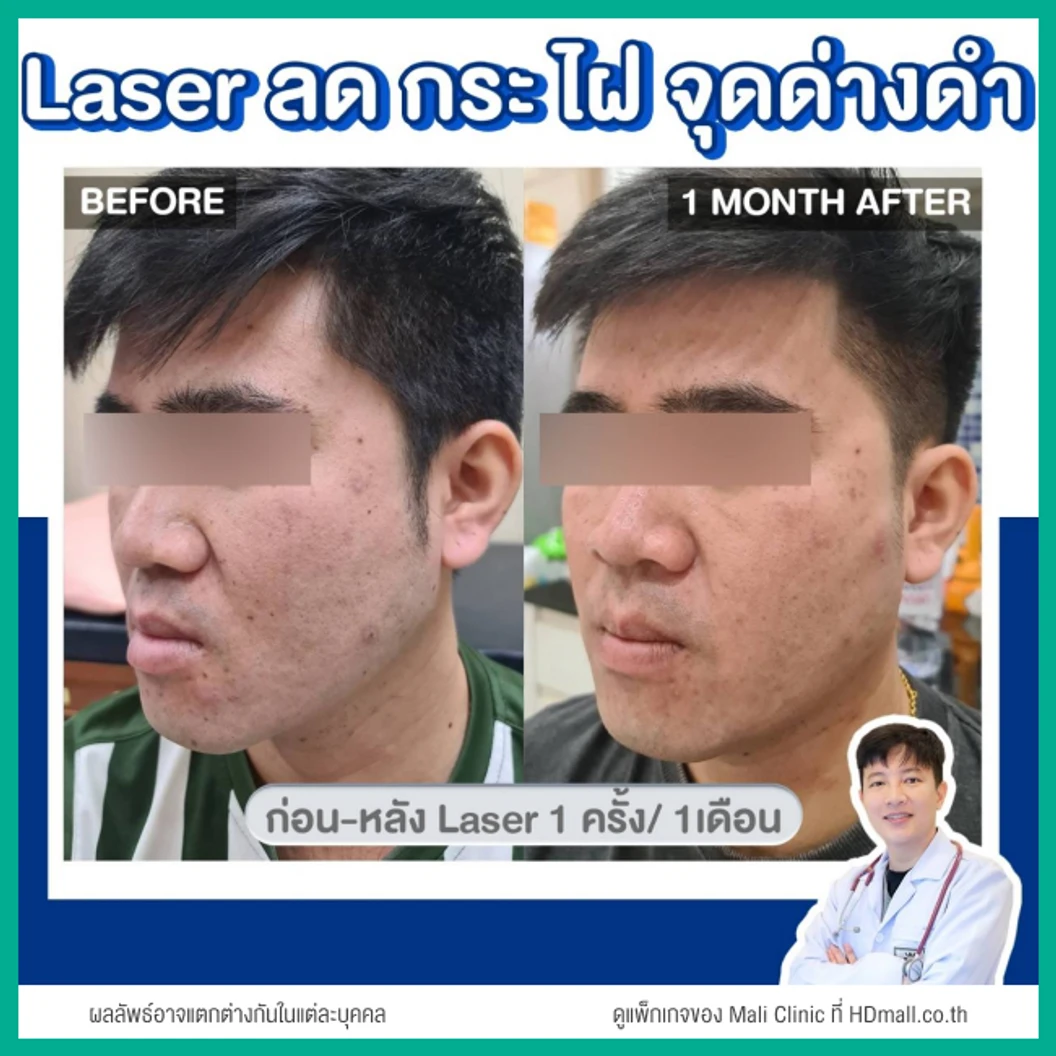 จี้ไฝ ขี้แมลงวัน ด้วยเลเซอร์ CO2 ไม่จำกัดเม็ด ทั่วใบหน้าและคอ 1 ครั้ง