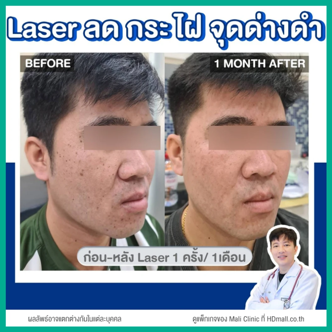 จี้ไฝ ขี้แมลงวัน ด้วยเลเซอร์ CO2 ไม่จำกัดเม็ด ทั่วใบหน้าและคอ 1 ครั้ง