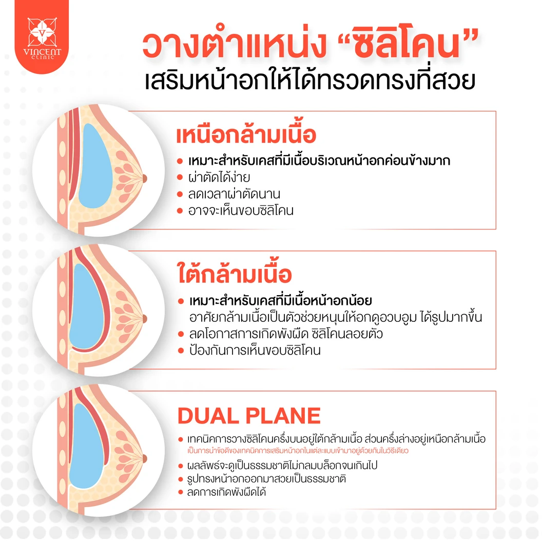 เสริมหน้าอก ด้วยซิลิโคน Mentor รุ่น Memory Gel ไม่จำกัดซีซี ขึ้นอยู่กับแพทย์ประเมิน สำหรับเคสทำครั้งแรก ที่ Vincent Clinic