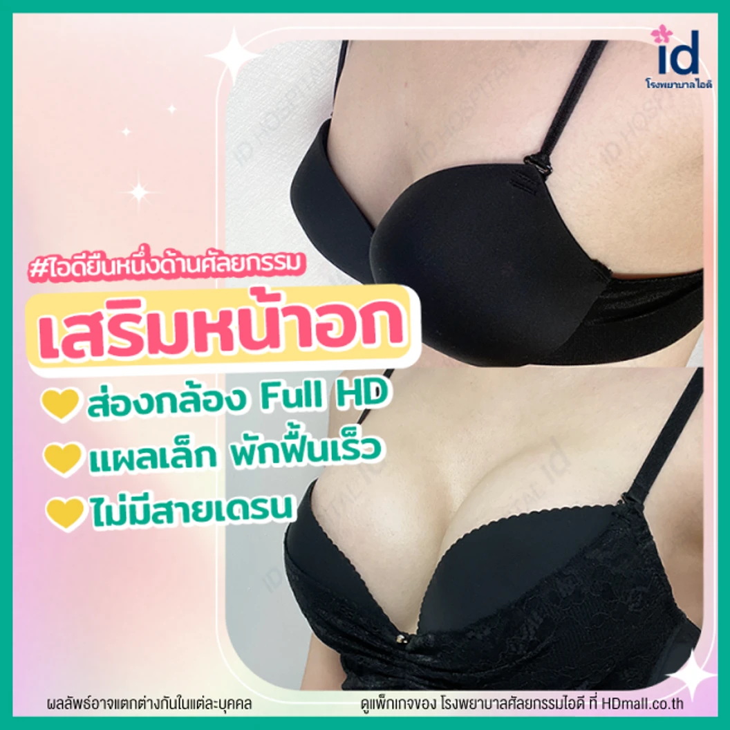 มัดจำเสริมหน้าอกด้วยซิลิโคน Mentor รุ่น Smooth Round หรือ Xtra Gel จำนวนซีซีขึ้นอยู่กับแพทย์ประเมิน สำหรับเคสทำครั้งแรก