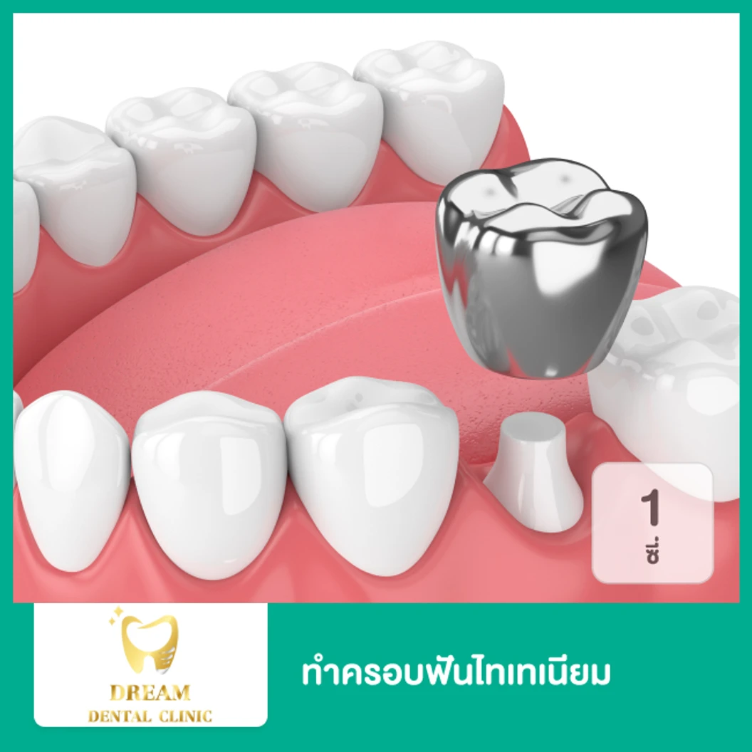 ทำครอบฟันไทเทเนียม (Titanium) 1 ซี่
