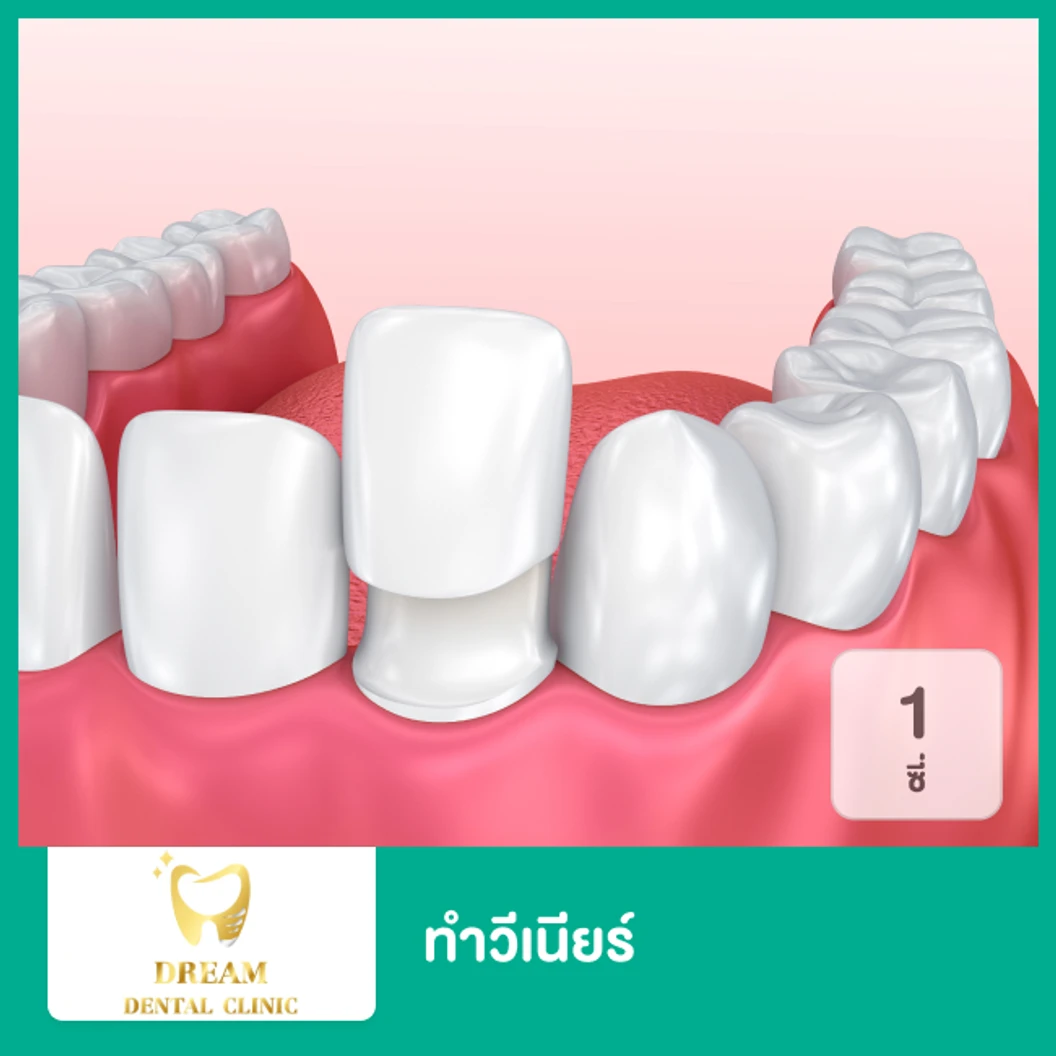 ทำวีเนียร์ EMax หรือ Zirconia IPS Empress The Ultimate in Metal-Free-Esthetics 1 ซี่