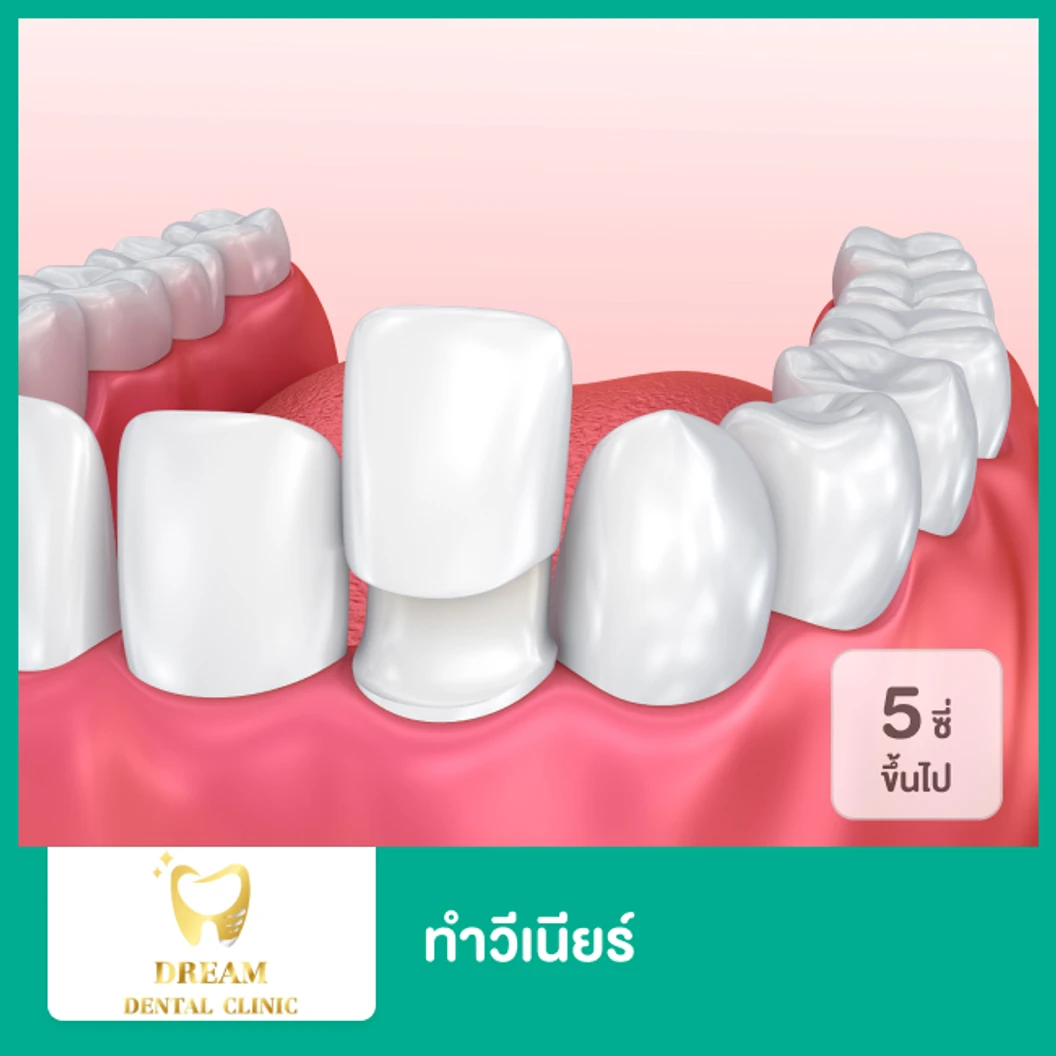 ทำวีเนียร์ EMax หรือ Zirconia IPS Empress The Ultimate in Metal-Free-Esthetics 5 ซี่ขึ้นไป (ราคาต่อ 1 ซี่)