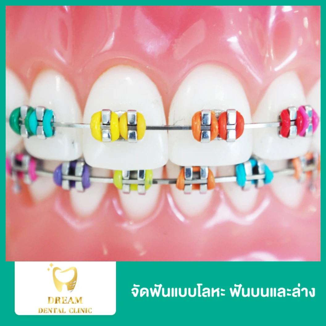 จัดฟันแบบโลหะ ฟันบนและล่าง