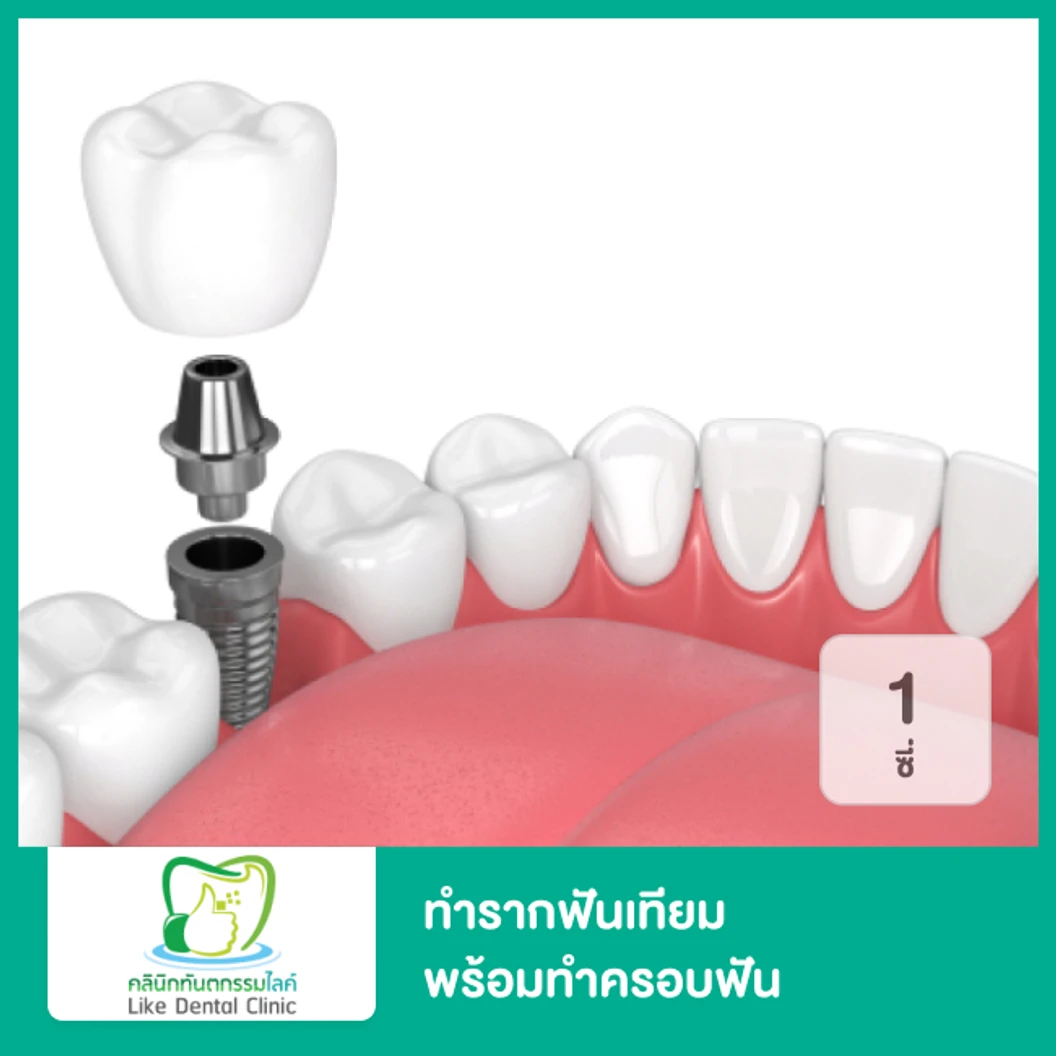 ทำรากฟันเทียม ยี่ห้อ Dentium พร้อมทำครอบฟัน สำหรับฟัน 1 ซี่