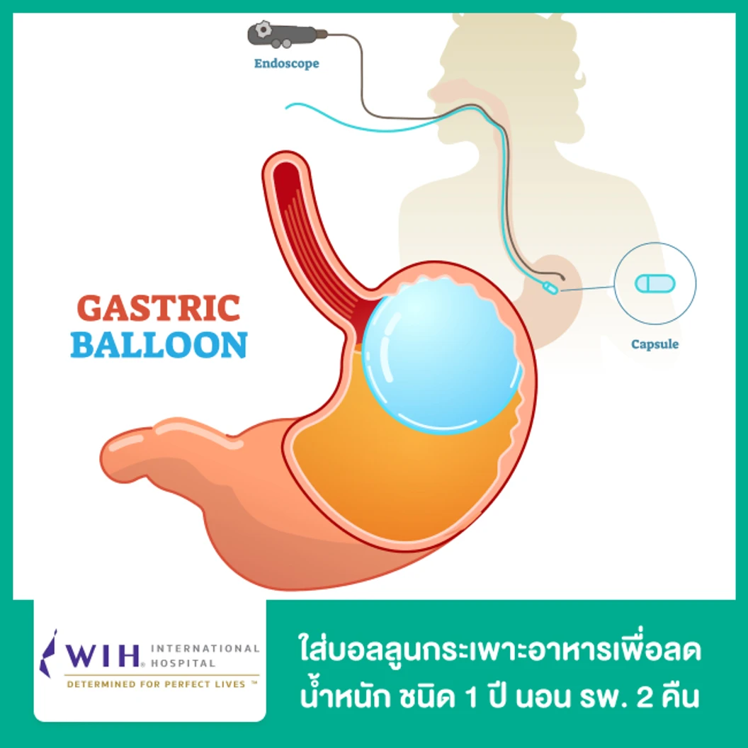 ใส่บอลลูนกระเพาะอาหารเพื่อลดน้ำหนัก (Gastric Balloon) ชนิด 6 เดือน นอน รพ. 1 คืน