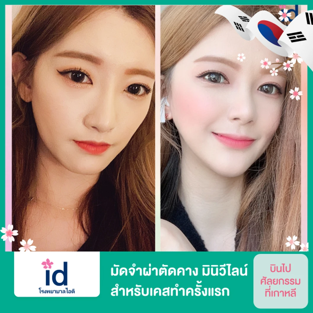 มัดจำผ่าตัดคาง มินิวีไลน์ (Mini V-Line) สำหรับเคสทำครั้งแรก