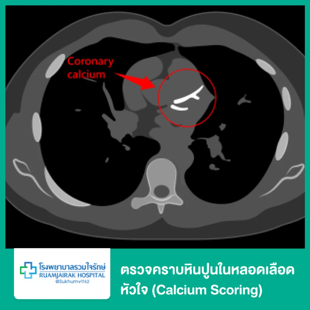 ตรวจคราบหินปูนในหลอดเลือดหัวใจ (Calcium Scoring)