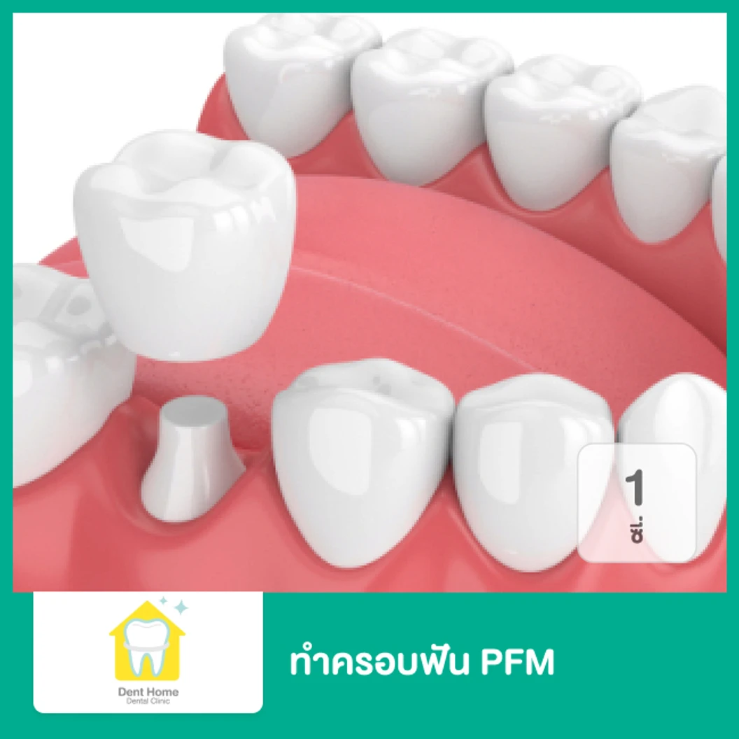 ทำครอบฟัน PFM 1 ซี่