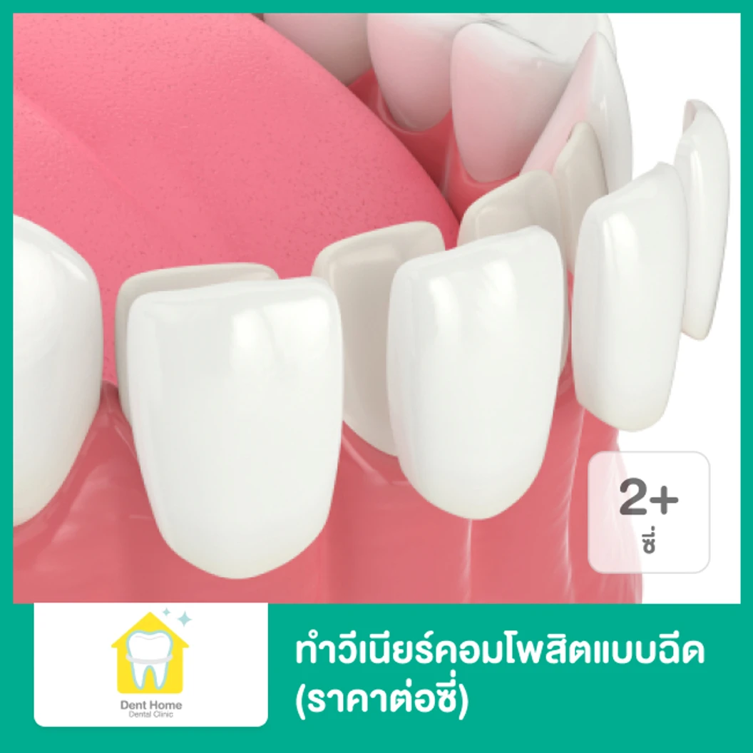 ทำวีเนียร์คอมโพสิตแบบฉีด สำหรับฟัน 2 ซี่ขึ้นไป (ราคาต่อซี่)