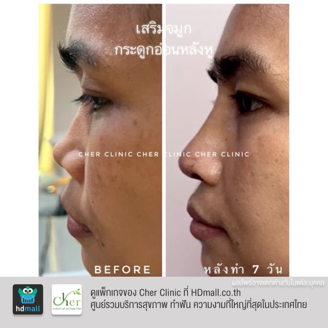 เสริมจมูก ด้วยซิลิโคนอเมริกาเกรดพรีเมียม สำหรับเคสทำครั้งแรก