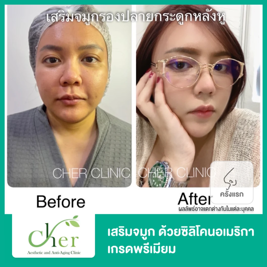 เสริมจมูก ด้วยซิลิโคนอเมริกาเกรดพรีเมียม สำหรับเคสทำครั้งแรก