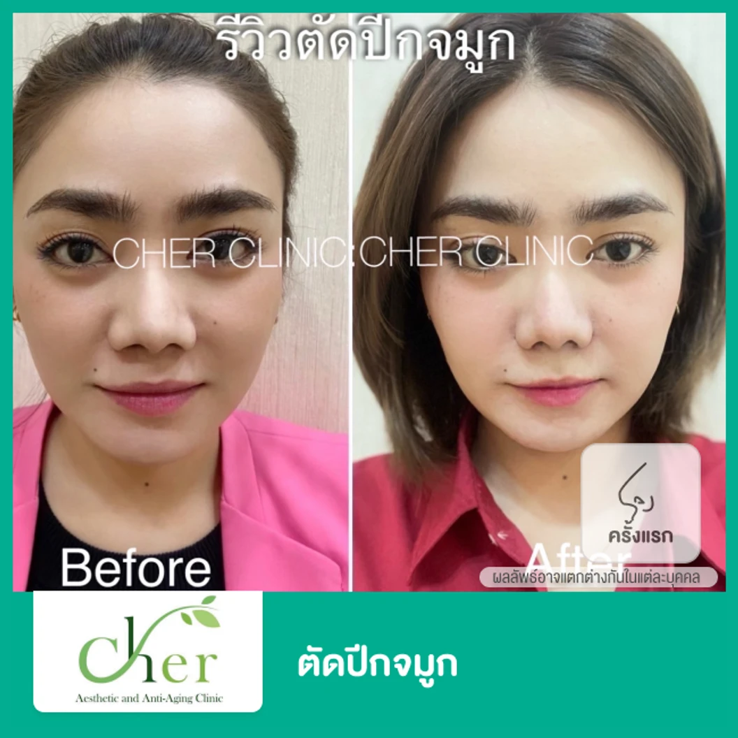 ตัดปีกจมูก สำหรับเคสทำครั้งแรก