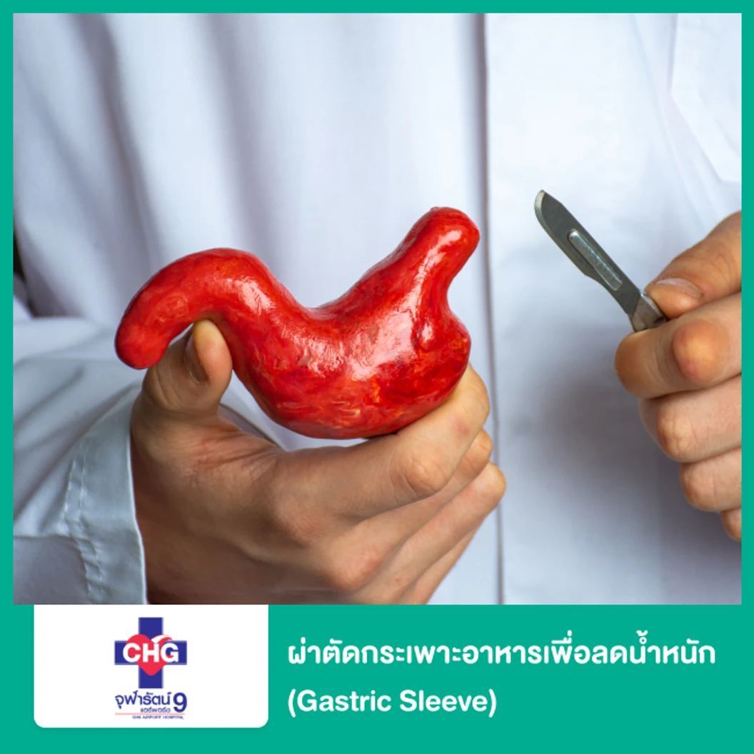 ผ่าตัดกระเพาะอาหารเพื่อลดน้ำหนัก (Gastric Sleeve)