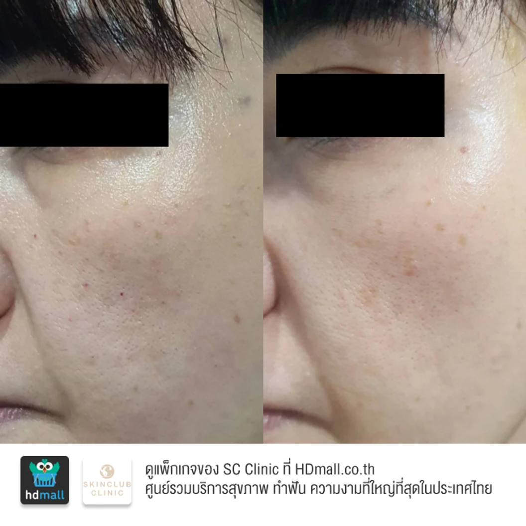 โปรแกรมเมโส Rejuran 2 ซีซี เพิ่มความชุ่มชื้น กระตุ้นการสร้างเซลล์ผิวใหม่ ลดเลือนริ้วรอย 1 ครั้ง