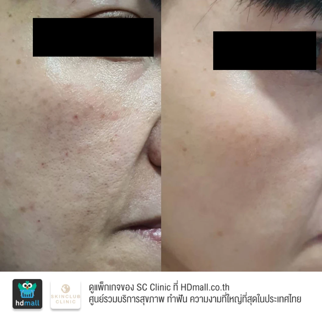 โปรแกรมเมโส Rejuran 2 ซีซี เพิ่มความชุ่มชื้น กระตุ้นการสร้างเซลล์ผิวใหม่ ลดเลือนริ้วรอย 1 ครั้ง