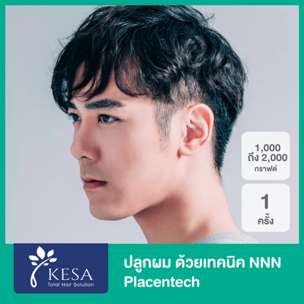ปลูกผม ด้วยเทคนิค NNN 2025 Placentech จำนวน 1,001-2,000 กราฟต์ 1 ครั้ง