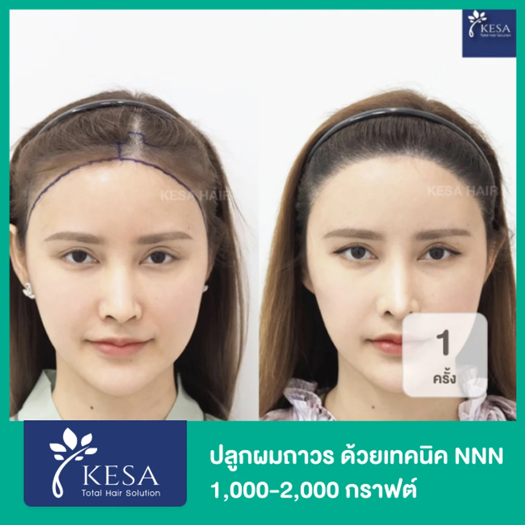 ปลูกผมถาวร ด้วยเทคนิค NNN 2025 จำนวน 1,001-2,000 กราฟต์ 1 ครั้ง