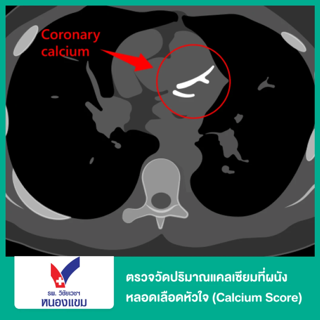 ตรวจวัดปริมาณแคลเซียมที่ผนังหลอดเลือดหัวใจ (Calcium Score)