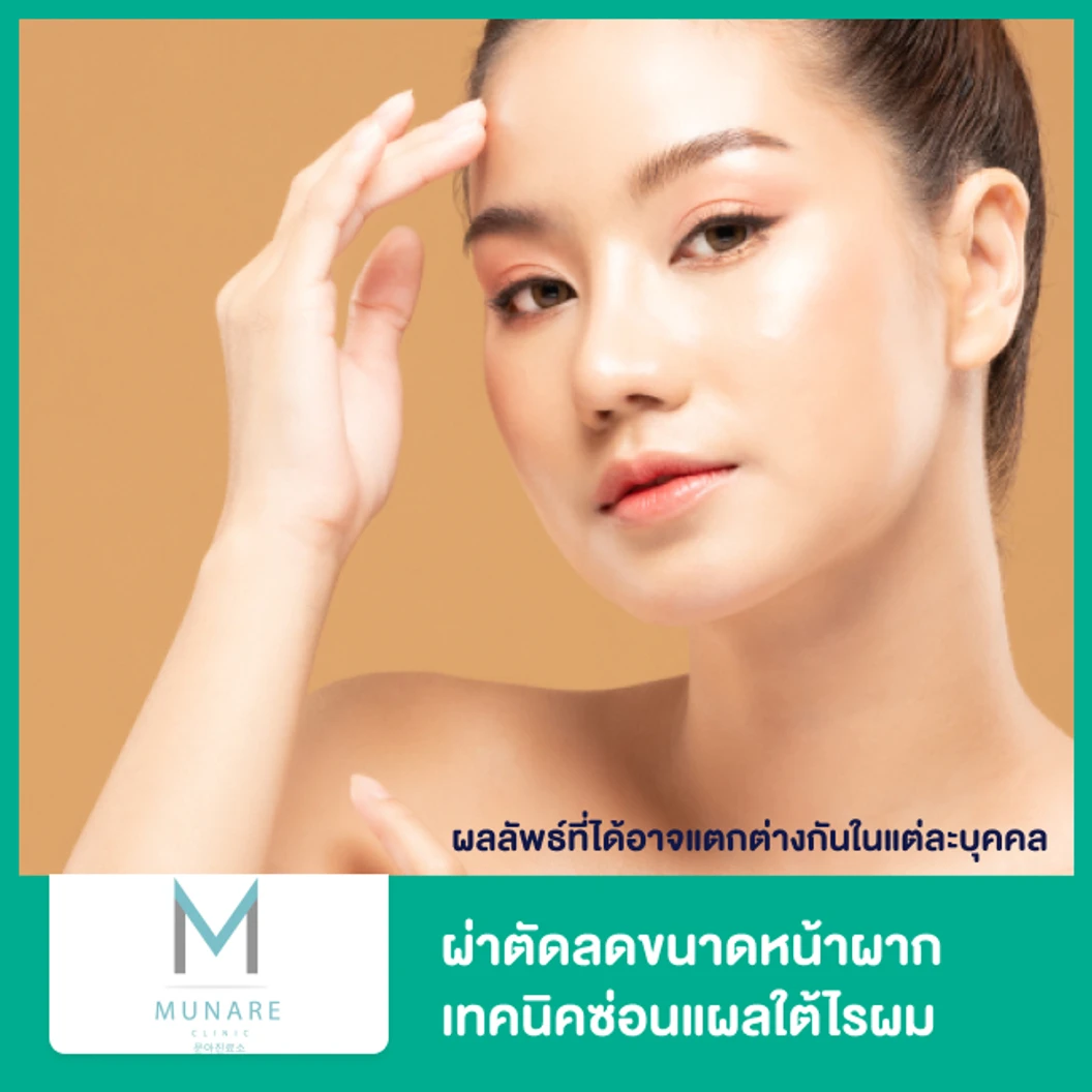 ผ่าตัดลดขนาดหน้าผาก เทคนิคซ่อนแผลใต้ไรผม