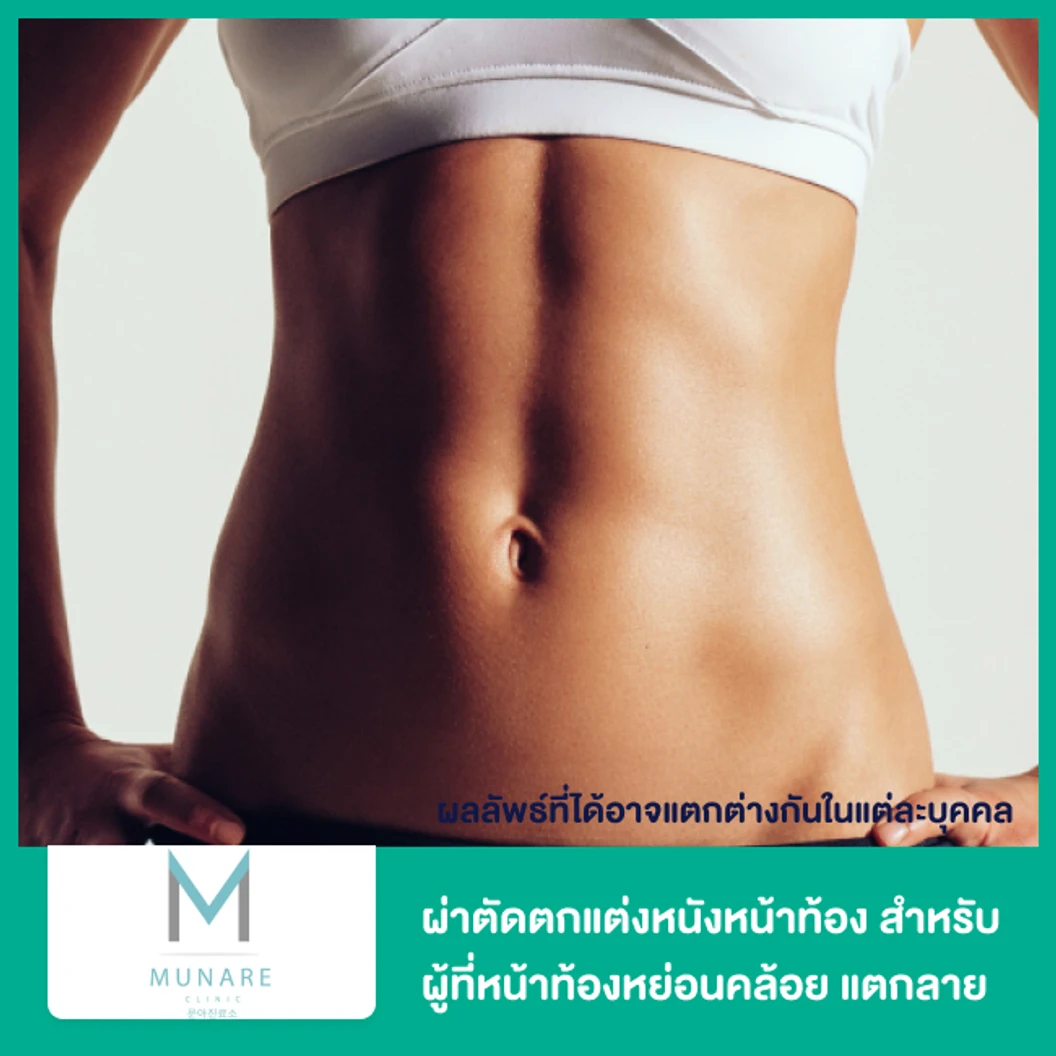 ผ่าตัดตกแต่งหนังหน้าท้อง สำหรับผู้ที่มีปัญหาหน้าท้องหย่อนคล้อย แตกลาย