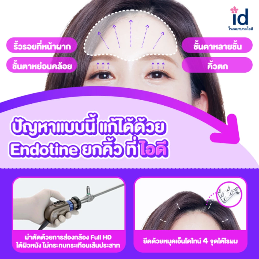 มัดจำยกคิ้ว ยกชั้นตา ด้วย Endotine สำหรับเคสทำครั้งแรก