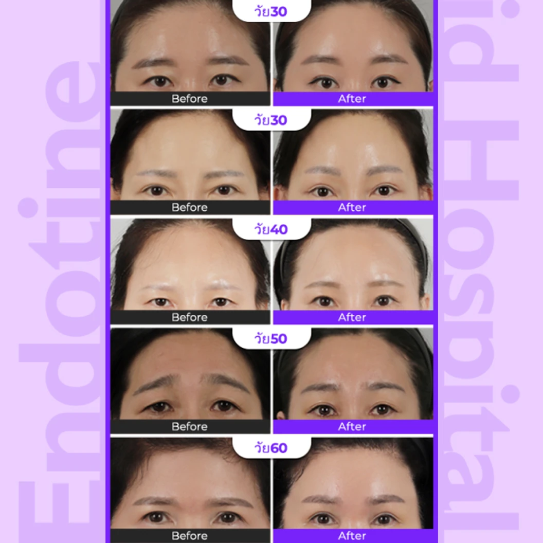 มัดจำยกคิ้ว ยกชั้นตา ด้วย Endotine สำหรับเคสทำครั้งแรก