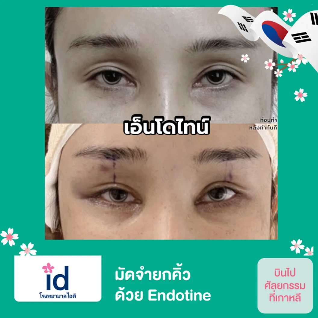 มัดจำยกคิ้ว ยกชั้นตา ด้วย Endotine สำหรับเคสทำครั้งแรก