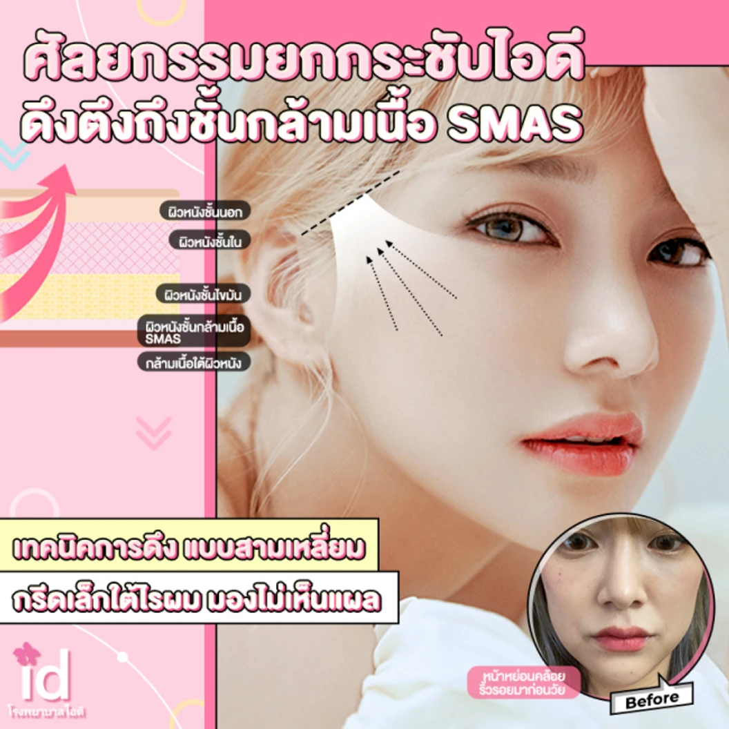 มัดจำยกกระชับใบหน้า สำหรับเคสทำครั้งแรก