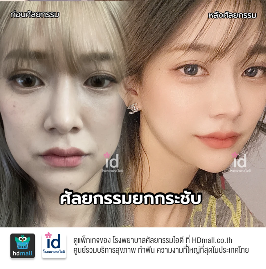 มัดจำยกกระชับใบหน้า สำหรับเคสทำครั้งแรก