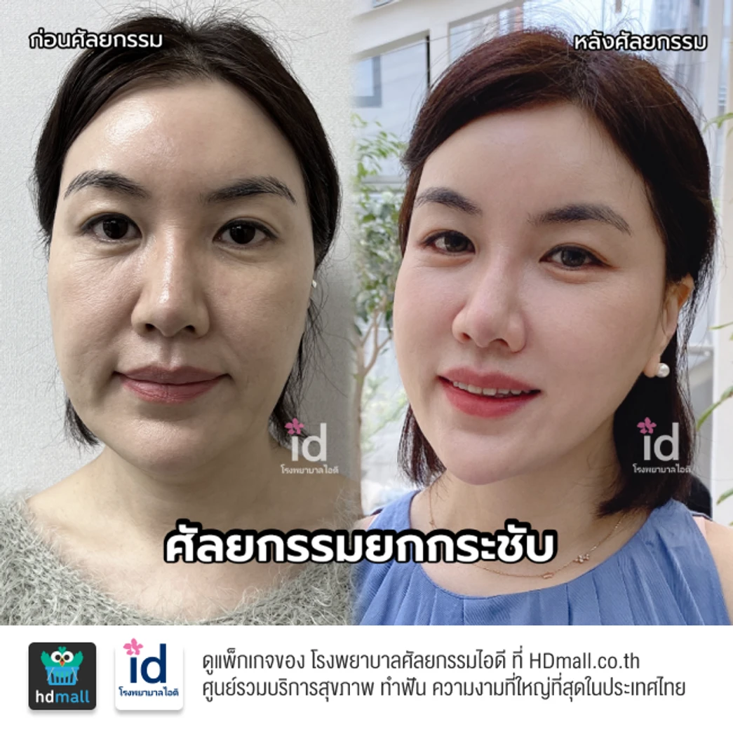 มัดจำยกกระชับใบหน้า สำหรับเคสทำครั้งแรก