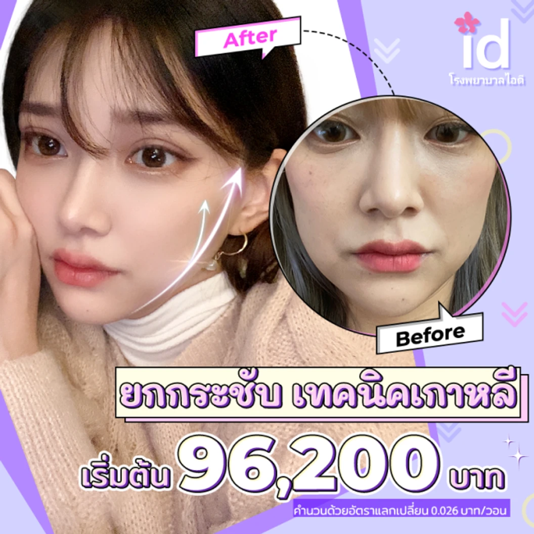 มัดจำยกกระชับใบหน้า สำหรับเคสทำครั้งแรก