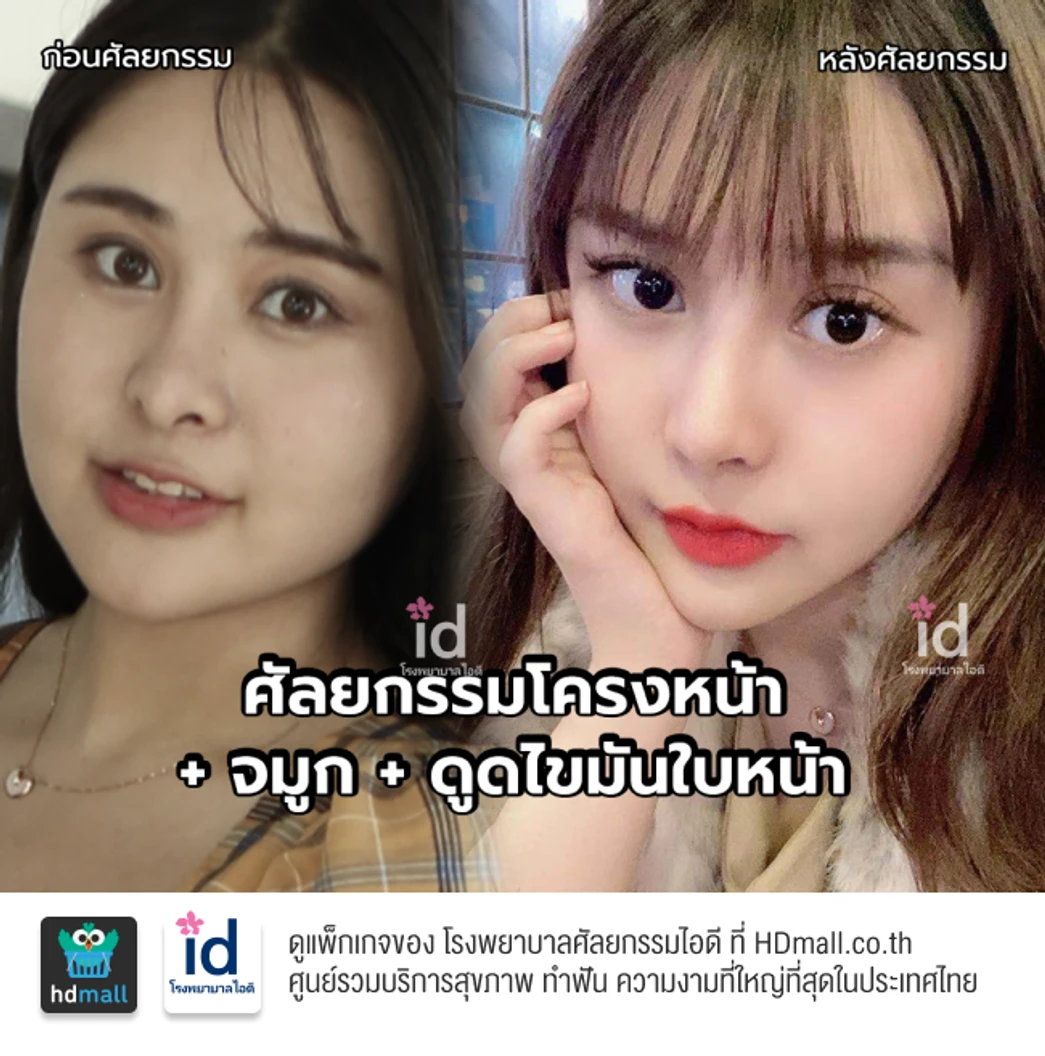 มัดจำเสริมจมูกแบบโอเพ่น 3 Steps สำหรับเคสทำครั้งแรก