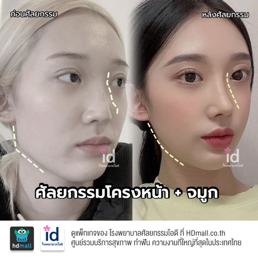 มัดจำเสริมจมูกแบบโอเพ่น 3 Steps สำหรับเคสทำครั้งแรก