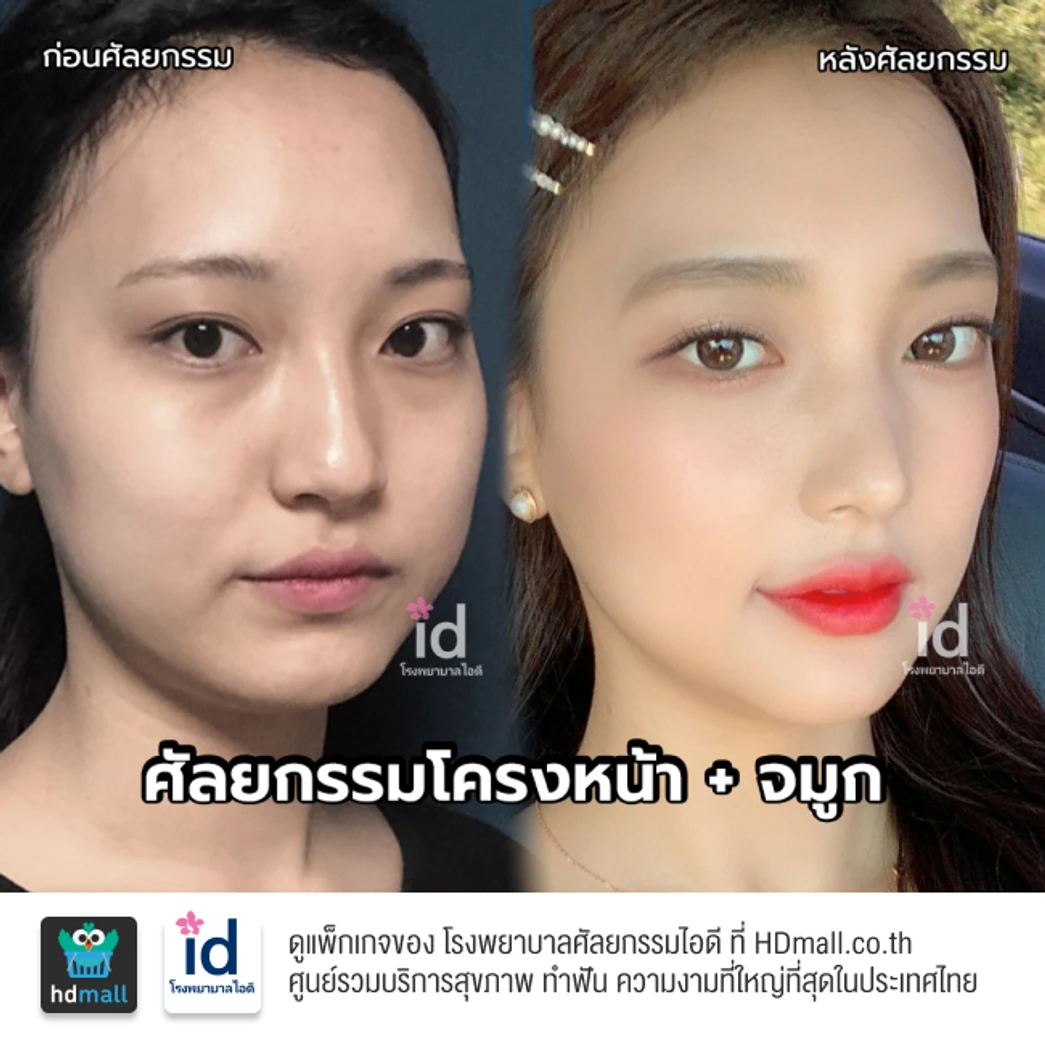 มัดจำเสริมจมูกแบบโอเพ่น 3 Steps สำหรับเคสทำครั้งแรก