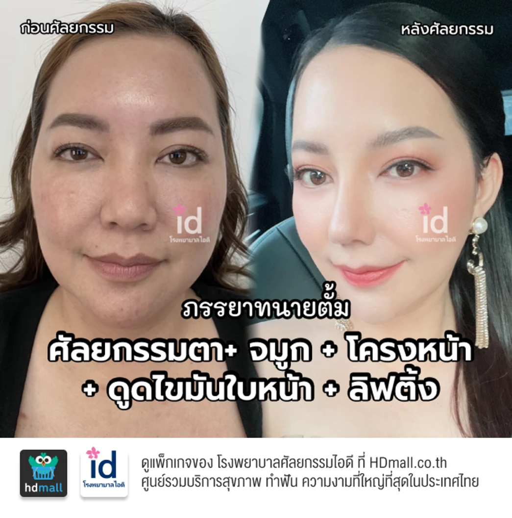 มัดจำเสริมจมูกแบบโอเพ่น 3 Steps สำหรับเคสทำครั้งแรก