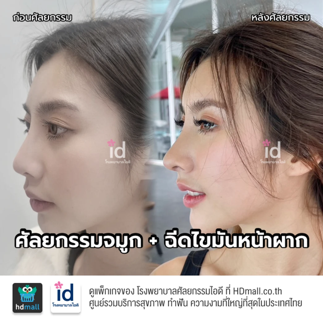 มัดจำเสริมจมูกแบบโอเพ่น 3 Steps สำหรับเคสทำครั้งแรก