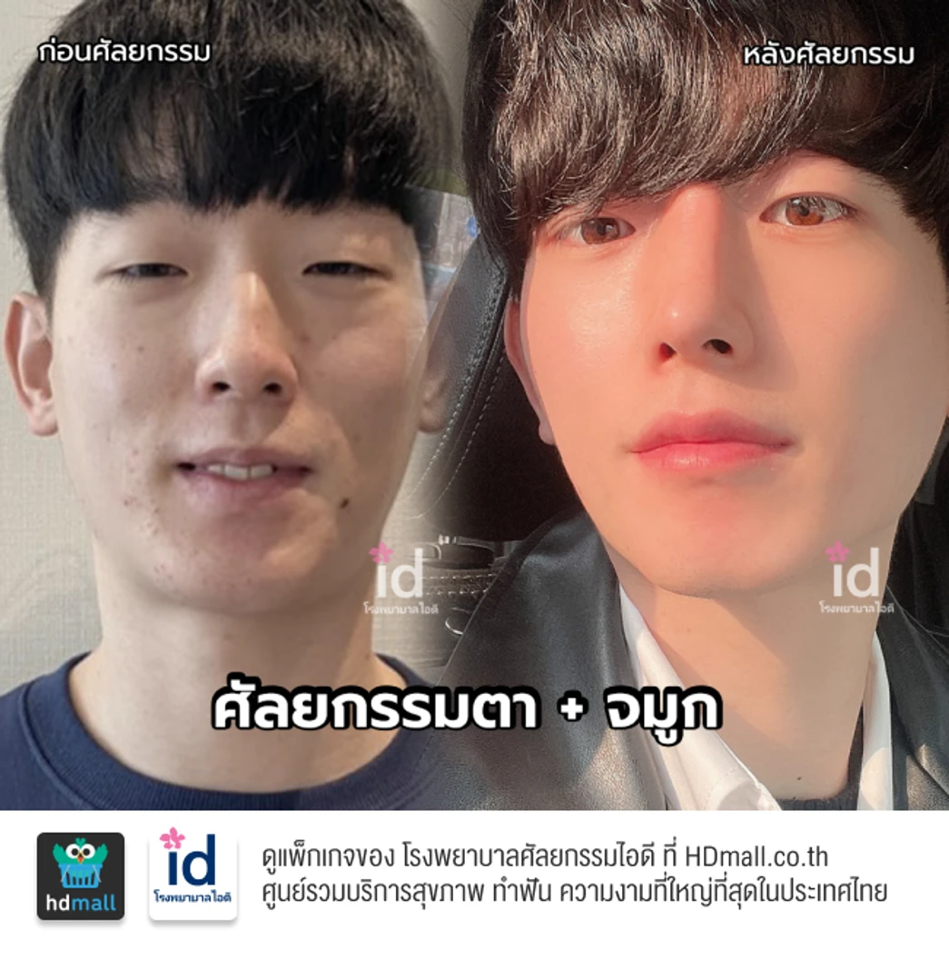 มัดจำเสริมจมูกแบบโอเพ่น 3 Steps สำหรับเคสทำครั้งแรก