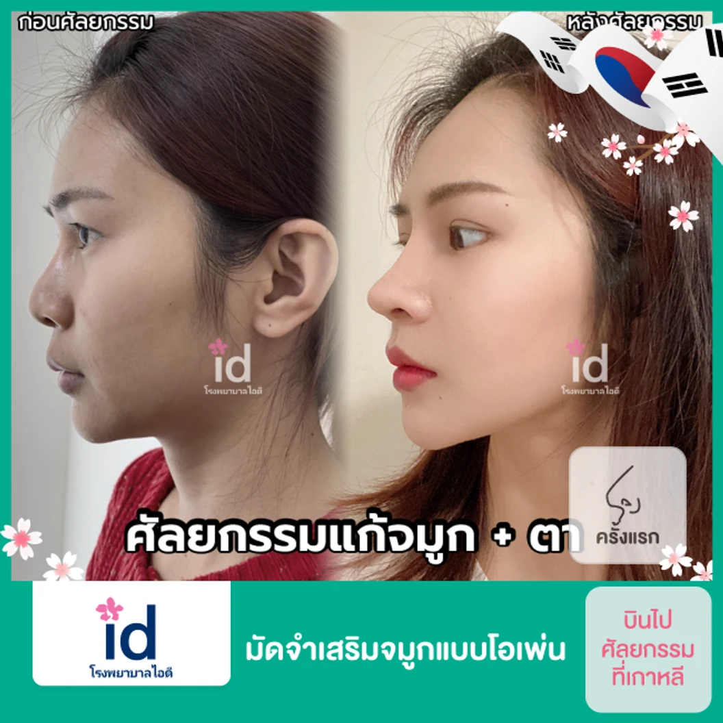 มัดจำเสริมจมูกแบบโอเพ่น 3 Steps สำหรับเคสทำครั้งแรก