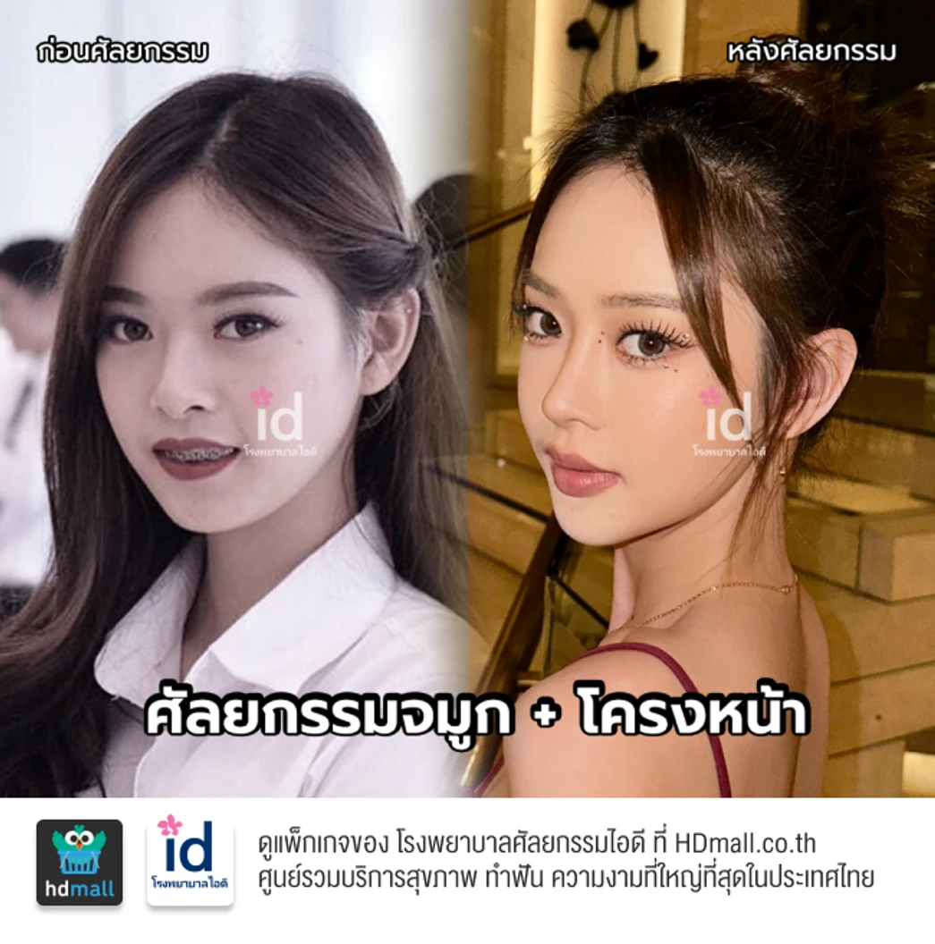 มัดจำเสริมจมูกแบบโอเพ่น 3 Steps สำหรับเคสแก้