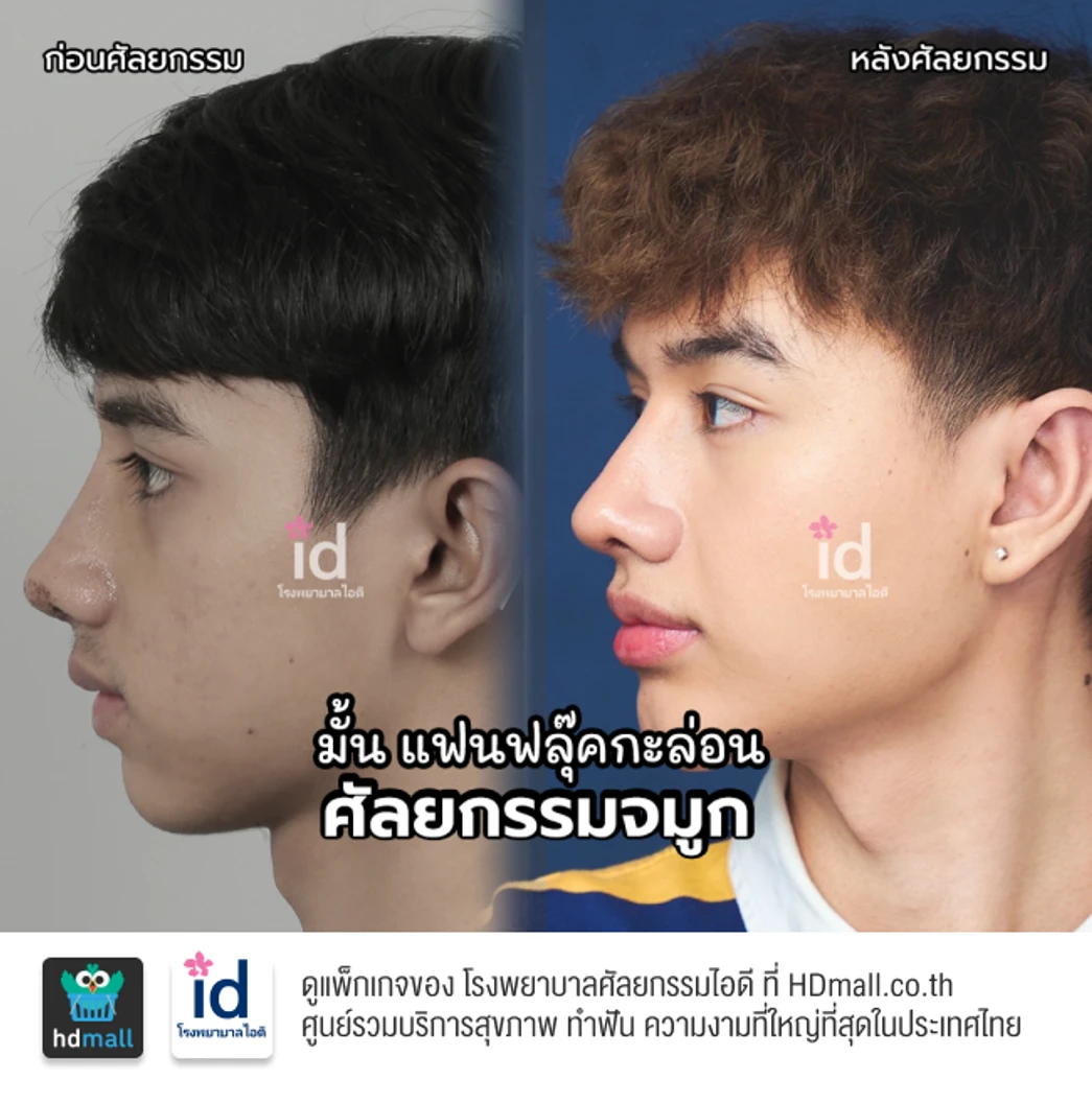 มัดจำเสริมจมูกแบบโอเพ่น 3 Steps สำหรับเคสแก้