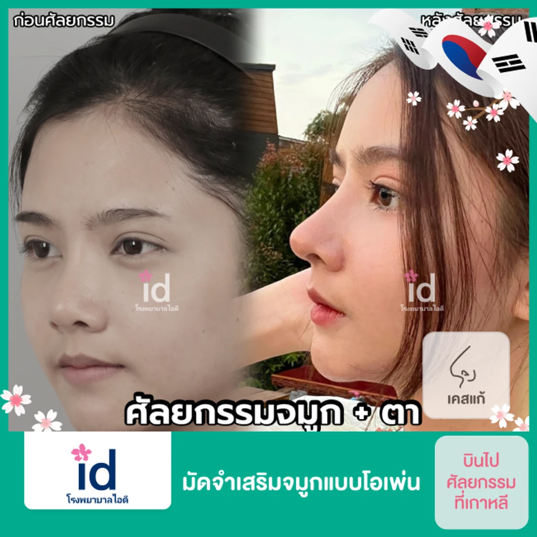 มัดจำเสริมจมูกแบบโอเพ่น 3 Steps สำหรับเคสแก้