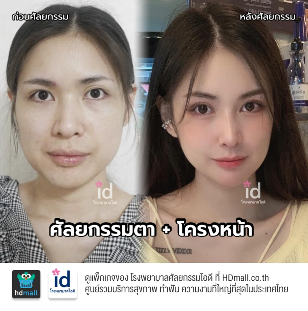 มัดจำผ่าตัดลดขนาดโหนกแก้ม สำหรับเคสทำครั้งแรก