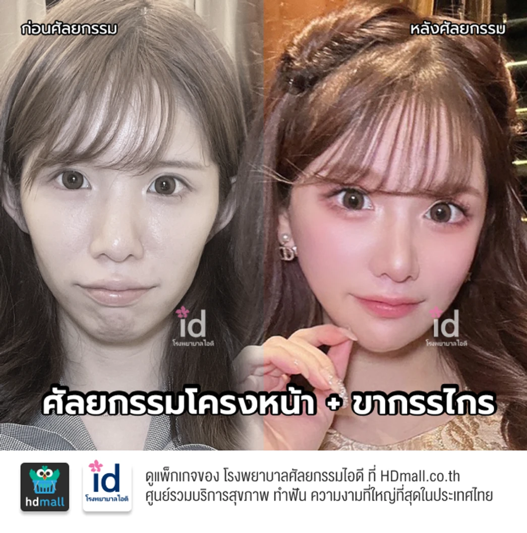 มัดจำผ่าตัดลดขนาดโหนกแก้ม สำหรับเคสทำครั้งแรก