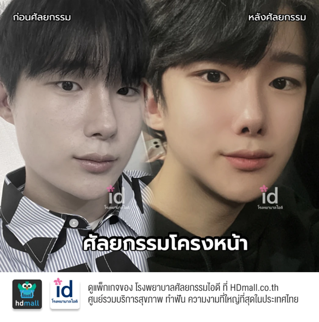 มัดจำผ่าตัดลดขนาดกราม สำหรับเคสทำครั้งแรก