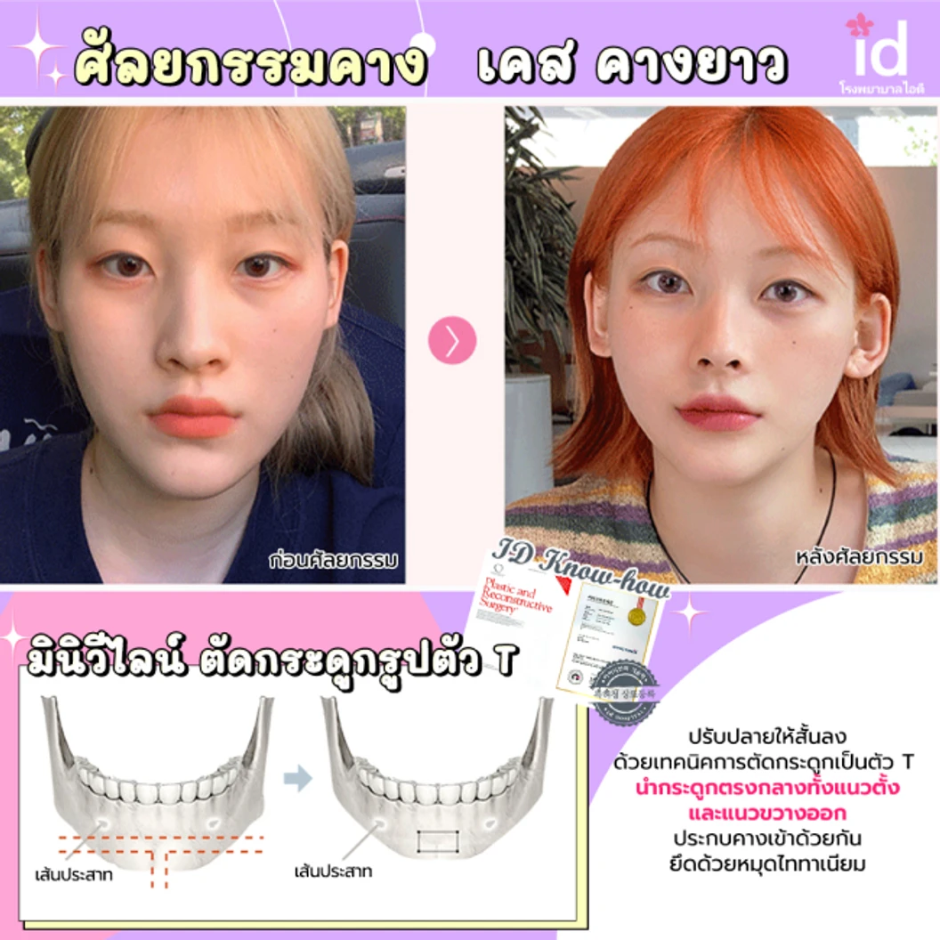 มัดจำผ่าตัดลดขนาดใบหน้า วีไลน์ บริเวณกรามและคาง สำหรับเคสทำครั้งแรก