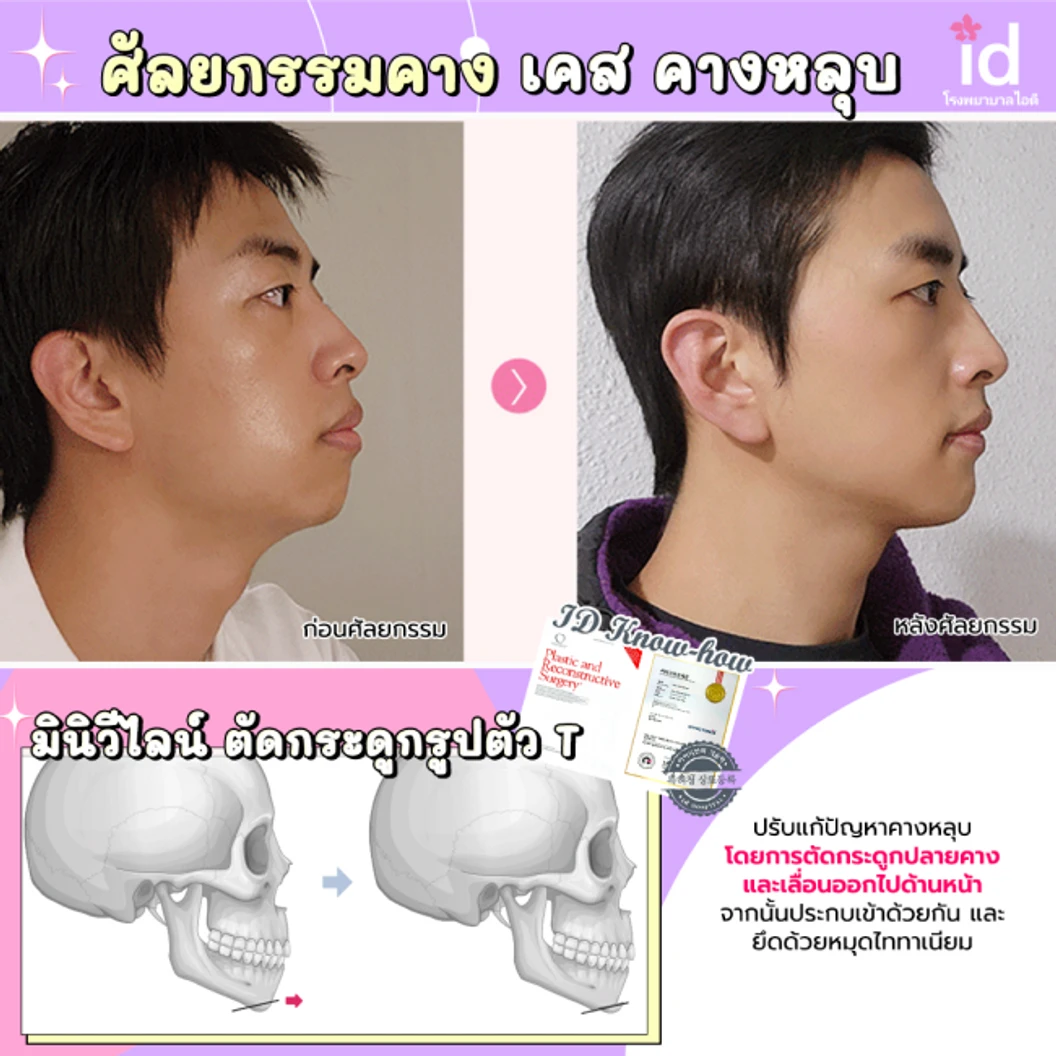 มัดจำผ่าตัดลดขนาดใบหน้า วีไลน์ บริเวณกรามและคาง สำหรับเคสทำครั้งแรก