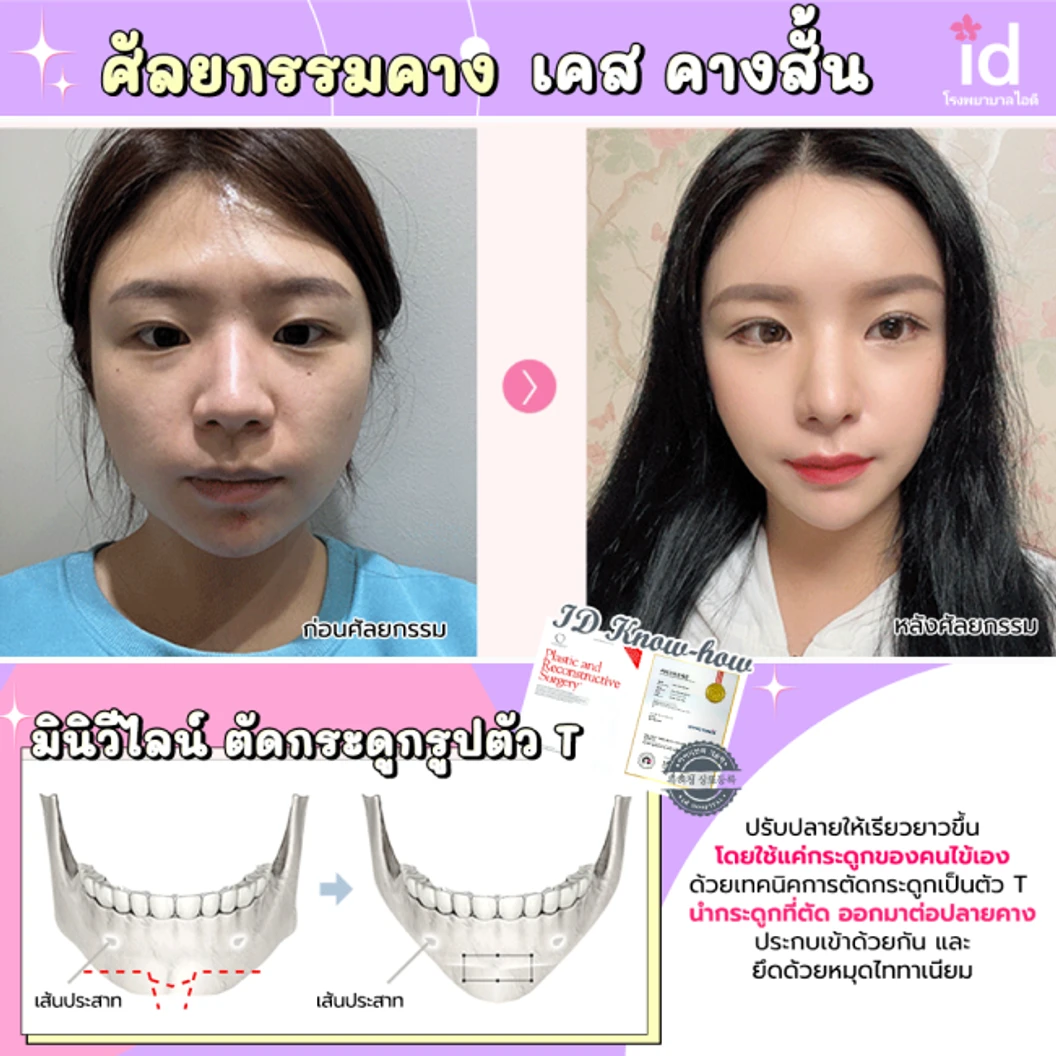 มัดจำผ่าตัดลดขนาดใบหน้า วีไลน์ บริเวณกรามและคาง สำหรับเคสทำครั้งแรก