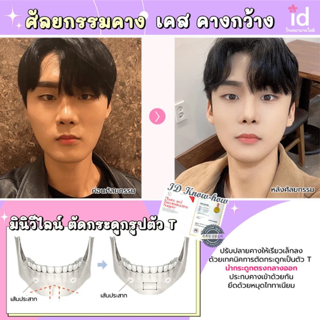 มัดจำผ่าตัดลดขนาดใบหน้า วีไลน์ บริเวณกรามและคาง สำหรับเคสทำครั้งแรก