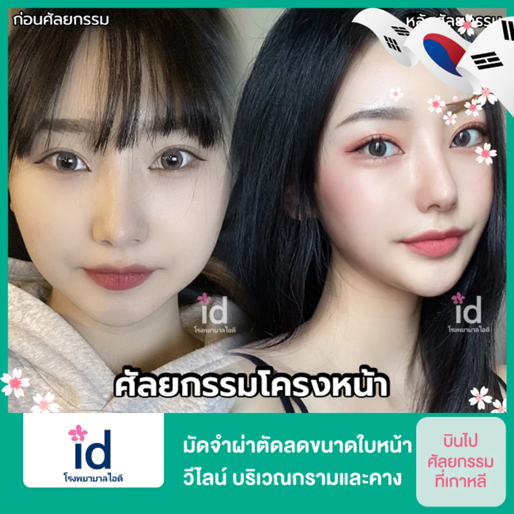 มัดจำผ่าตัดลดขนาดใบหน้า วีไลน์ บริเวณกรามและคาง สำหรับเคสทำครั้งแรก